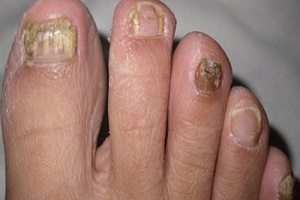 灰指甲护理的方法有哪些